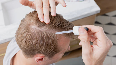 Minoxidil as treatment for hair loss