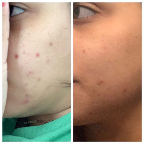 Microneedle before and after, clear skin after 3 weeks of usage