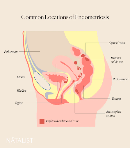 Natalist image depicting common locations of endometriosis in the abdominal region