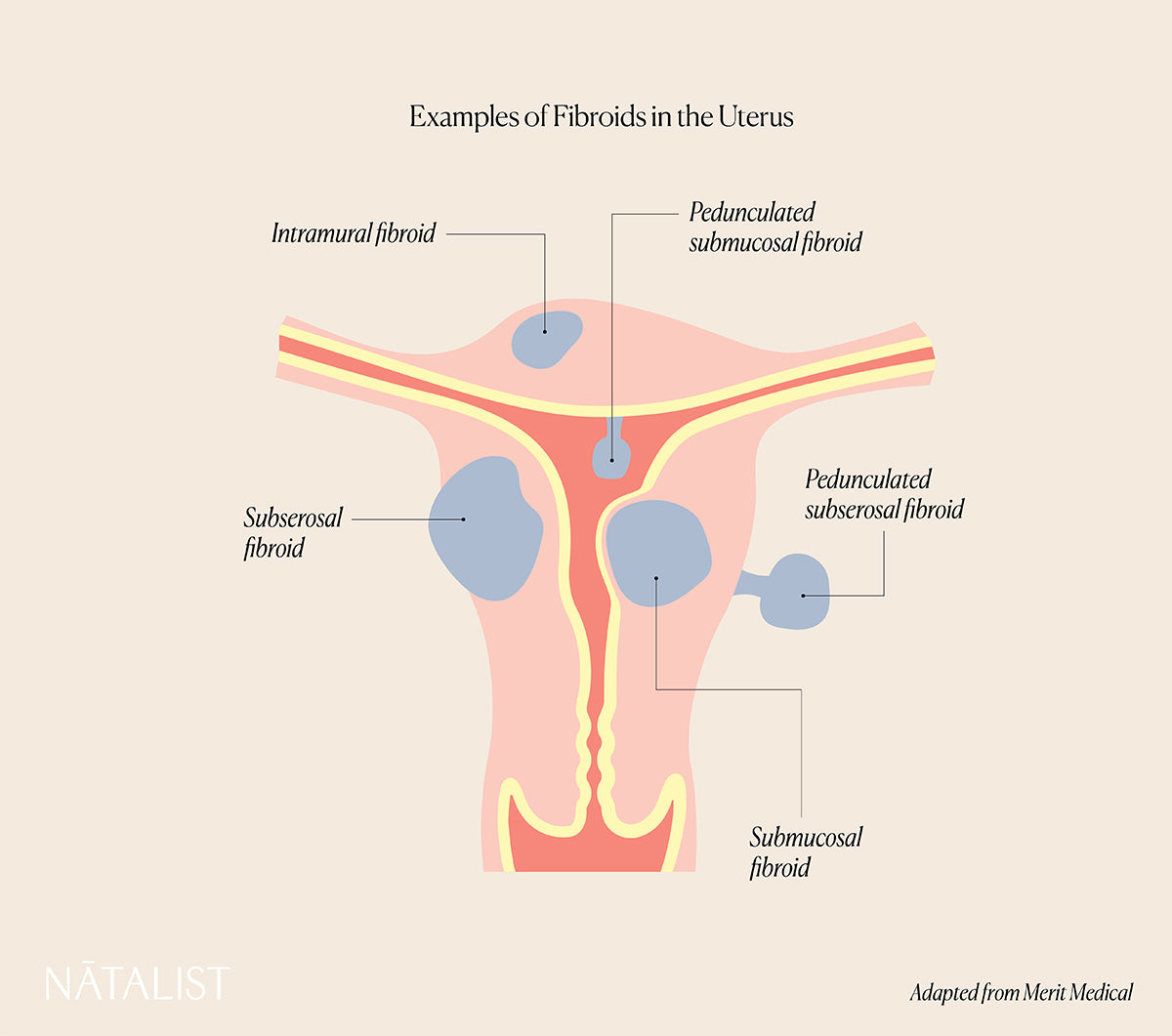 Natalist illustration showing location of various uterine fibroids