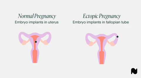 Pregnancy diagram