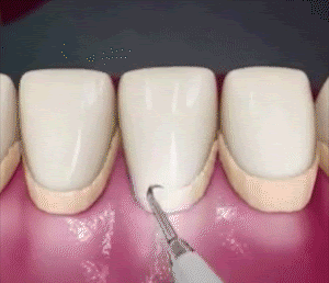 Détartreur dentaire à ultrasons Detartre-Pro™