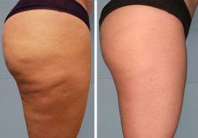 Dermaroller Cellulite