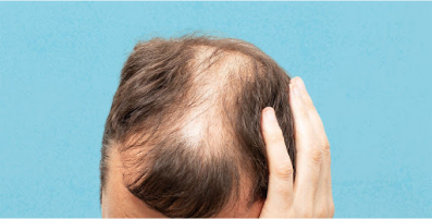 Androgenetic Alopecia (Male/Female Pattern Baldness)