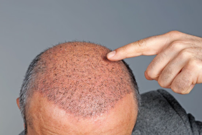 Follicle Transplantation