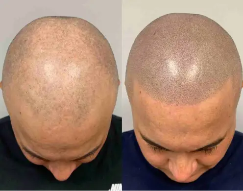 Signs of male pattern baldness