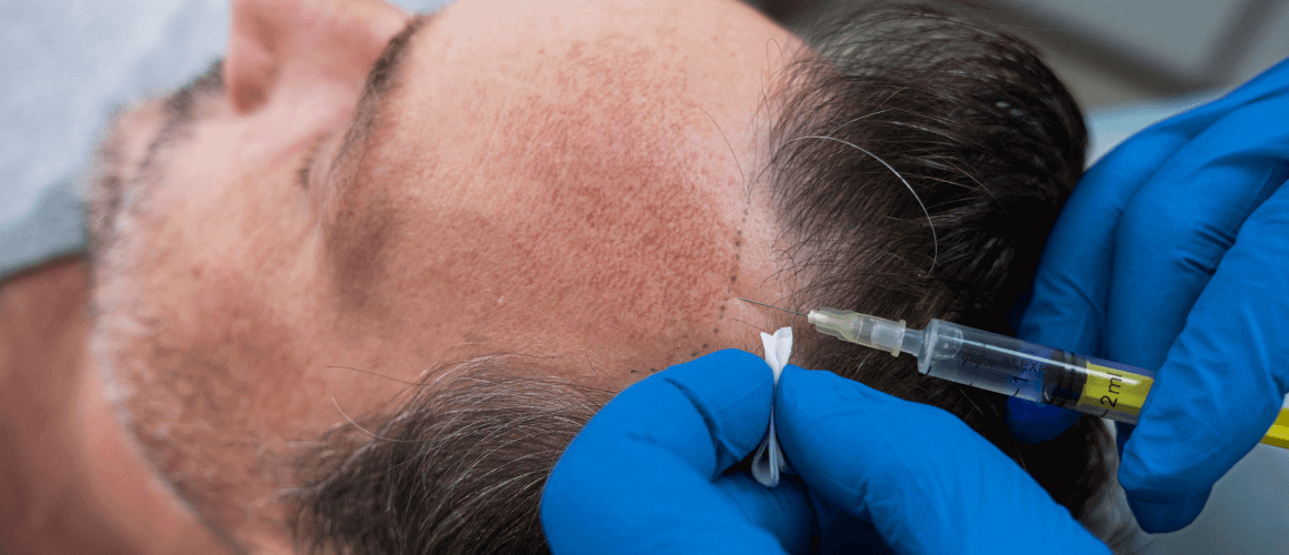 How SMP can Treat Male Pattern Baldness