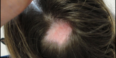 Scarring Alopecia