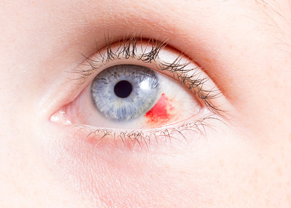 bloodshot in the eye caused by under-eye patch