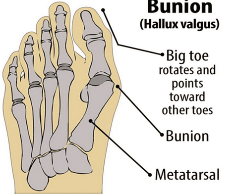 Bunion Corrector Relief Kit for Beginners - 6 Pack