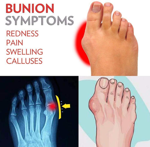 Women's Orthotic Sandals for Bunions