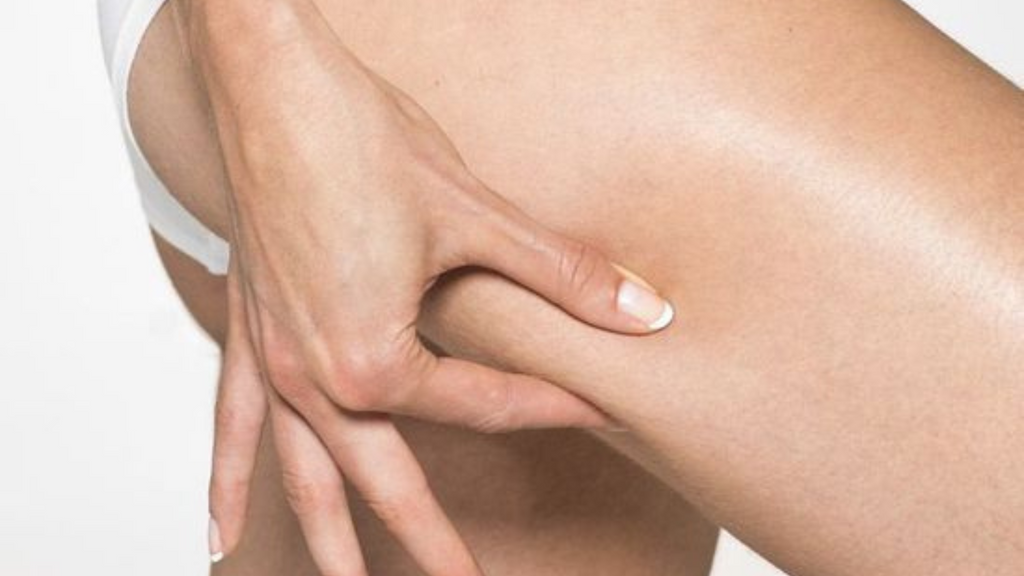 Femme se pinçant la peau des cuisses pour révéler sa cellulite