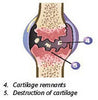 osteoarthritis