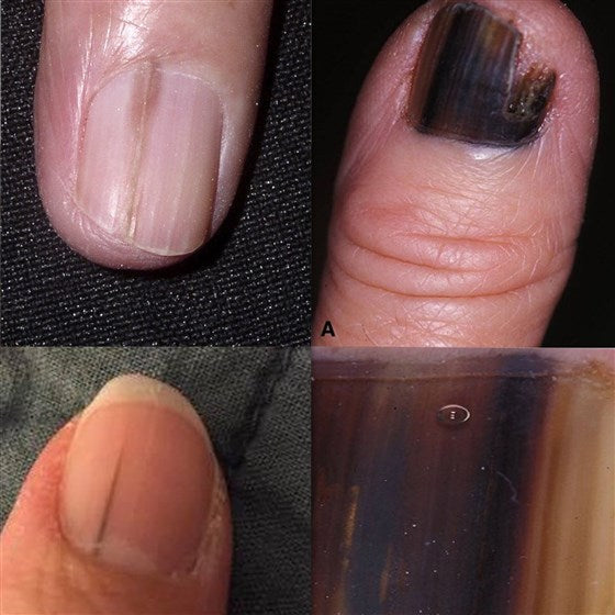 WHAT DOES NAIL MELANOMA LOOK LIKE? – Ani Michele Products