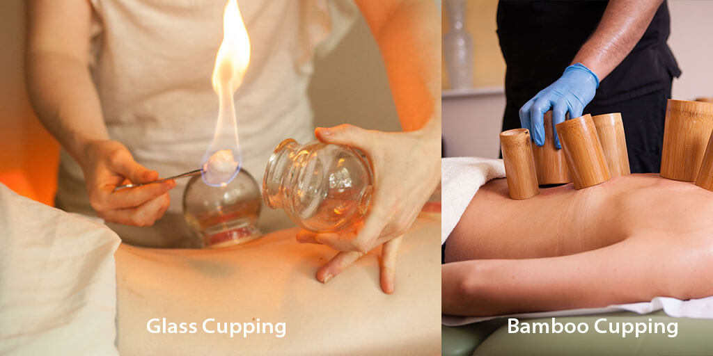 dry cupping therapy