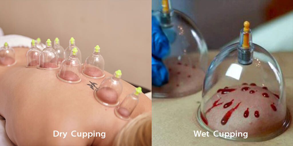 wet cupping therapy