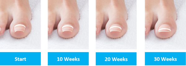 Feet with noticeably healthier-looking toenails after weeks of care. with Onyfix