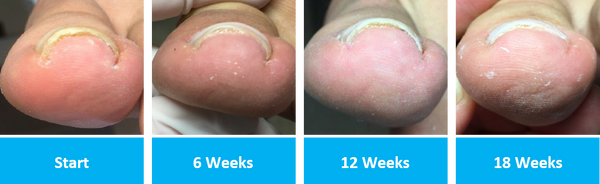 Untreated, damaged toenails before Onyfix foot care treatment.