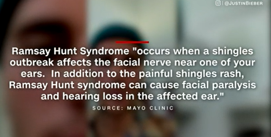 Ramsay Hunt Syndrome from Mayo clinic shared by Mettalusso