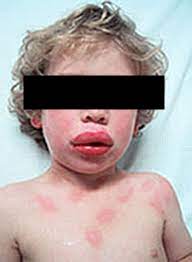 Image shows a child with swollen lips and red bumps and hives all over their body and cheeks. There is a black bar covering the child's eyes