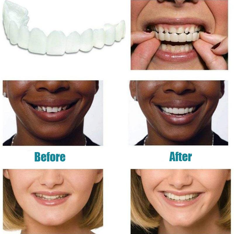 【IMITED SALE】-Perfect Smile Snap-On Braces