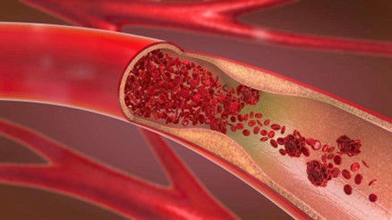 blood flowing through inflamed blood vessel