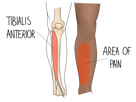 Shin splints, or medial tibial stress syndrome (MTSS), refer to pain along the inner edge of your shinbone (tibia). These painful sensations occur when the muscles, tendons, and bone tissues around the shin become inflamed due to repetitive stress.