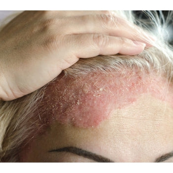 psoriasis on a ladies forehead