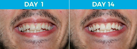 6 Shades Whiter Teeth - 24-Year Old Male Smoker Using White Birch™ Charcoal Toothpaste