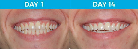 4 Shades Whiter - 18-Year Old Male Non-Smoker Using White Birch™ Charcoal Toothpaste