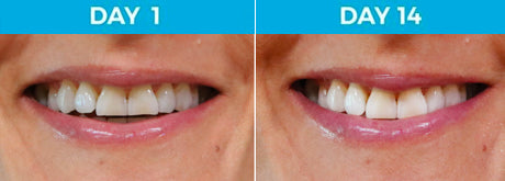 6 Shades Whiter - 42-Year Old Female Non-Smoker Using White Birch™ Charcoal Toothpaste