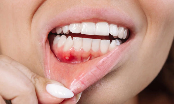 Ursachen Zahnfleischbluten – blutendes Zahnfleisch am Unterkiefer