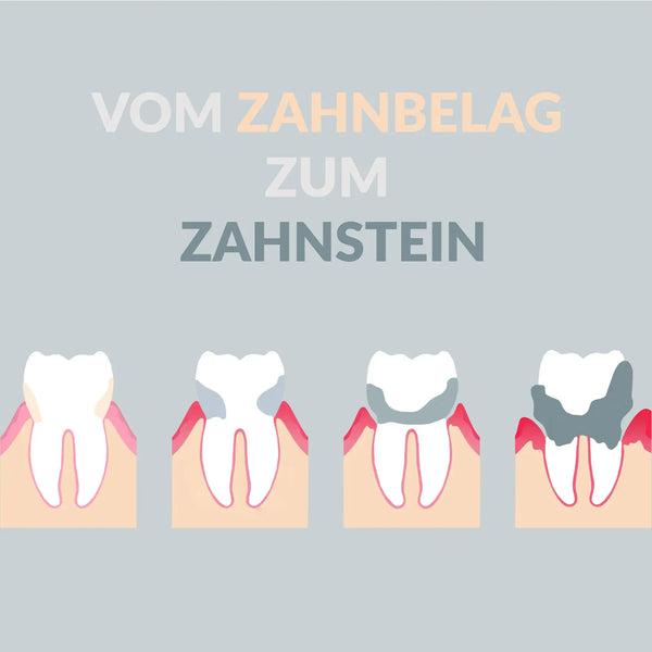 Zahnstein: Vom Zahnbelag zum Zahnstein