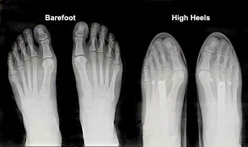 脚后跟与宽脚趾盒的 X 射线对比