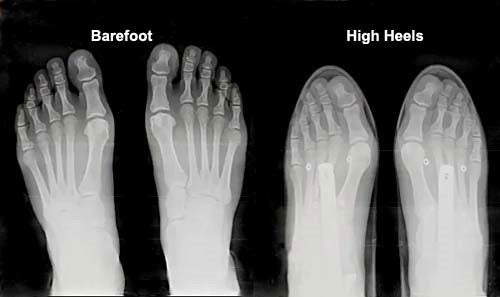 xray-of-heels-vs-wide-toe-box