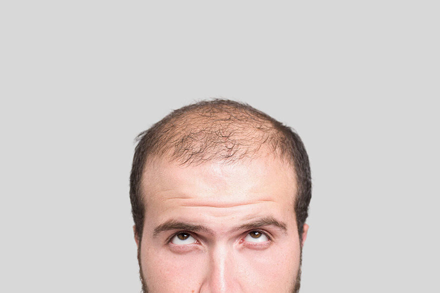 Male Pattern Baldness