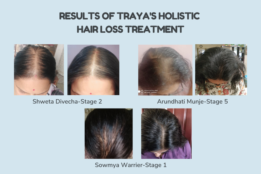 A Case Study of Female Pattern Hair Loss Improved in Women by Traya's