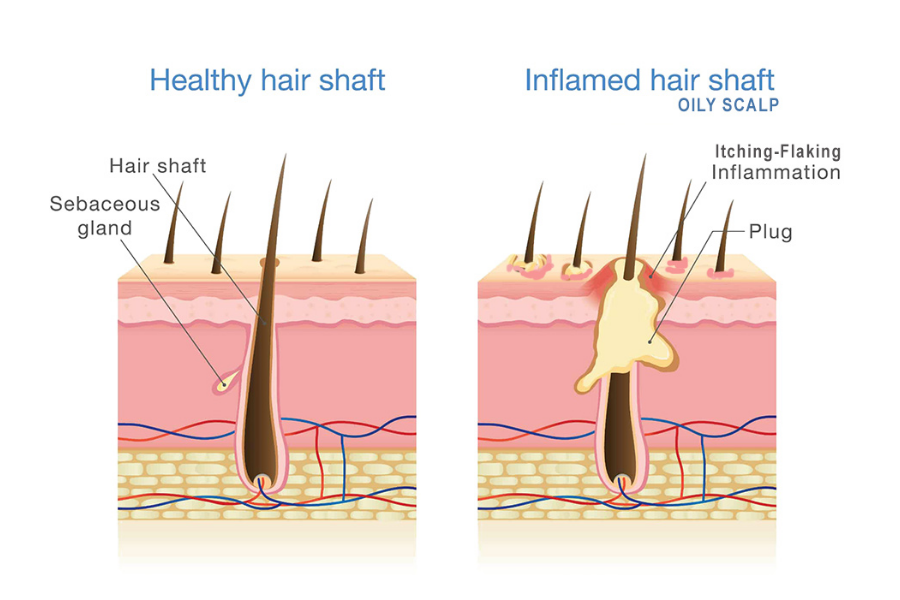 Oily Hair Oily Hair Causes Symptoms Treatment Traya