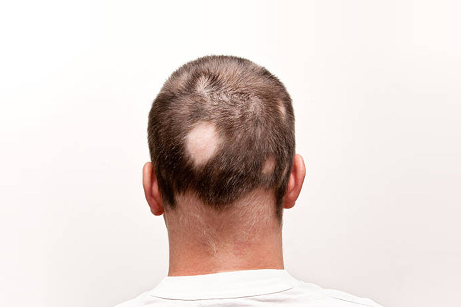 Alopecia Areata