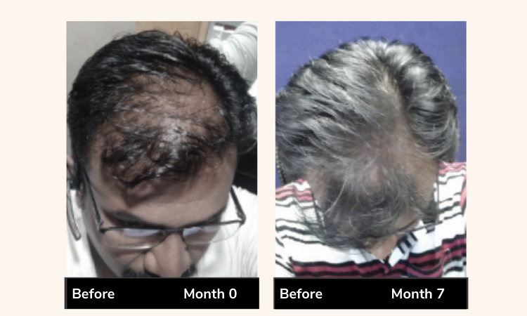 Why Am I Losing More Hair After Just Starting Hair Loss Treatment