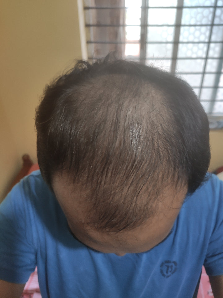 Male pattern hair loss