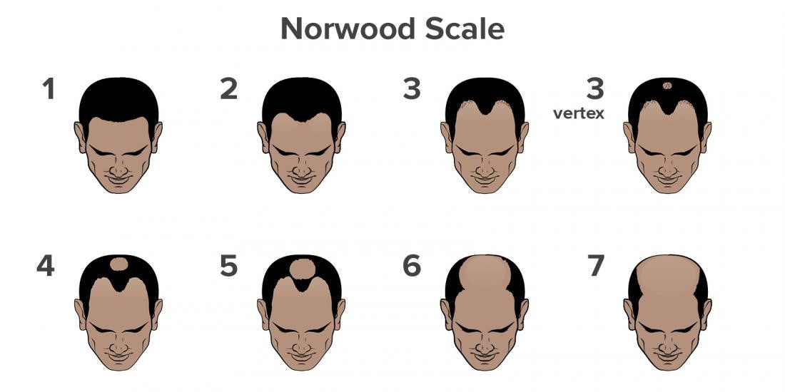 Norwood Hair Loss Scale- Stage wise for Men