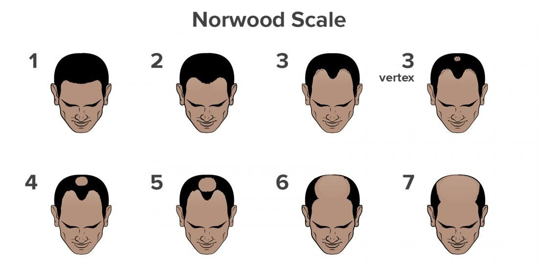 Hair Loss Statistics in India: Insights from 5 Lakh Indian Men | Traya  Health