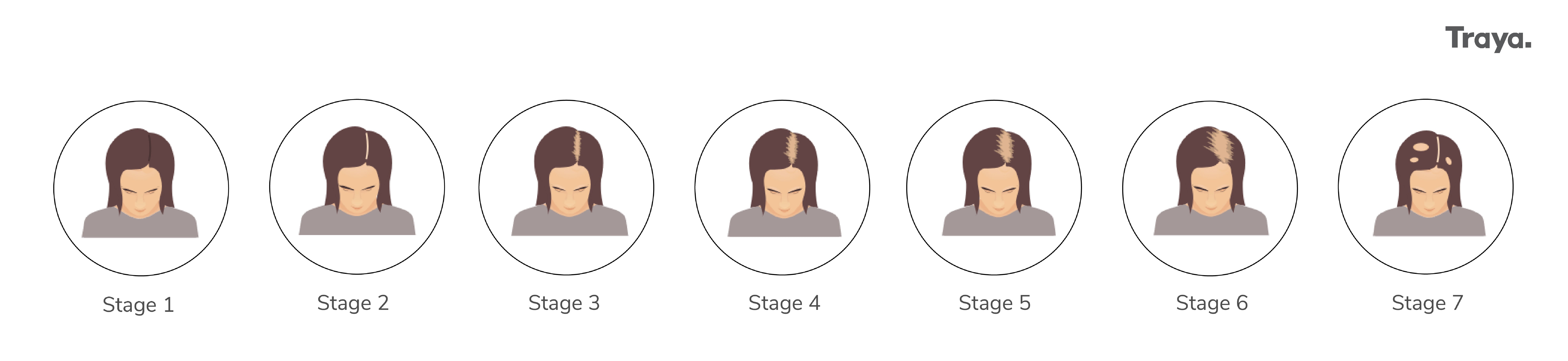 stages of hair fall in women