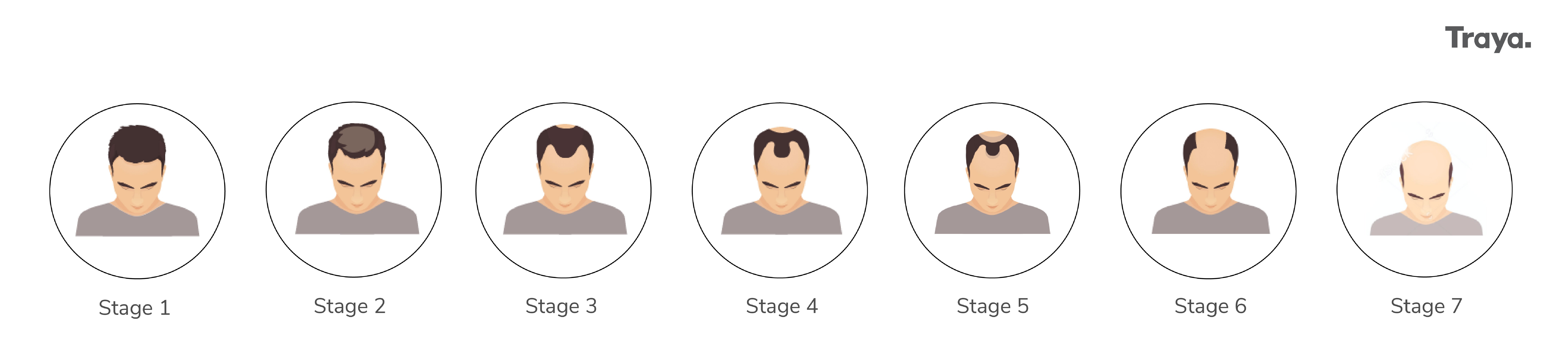 stages of hair fall in men