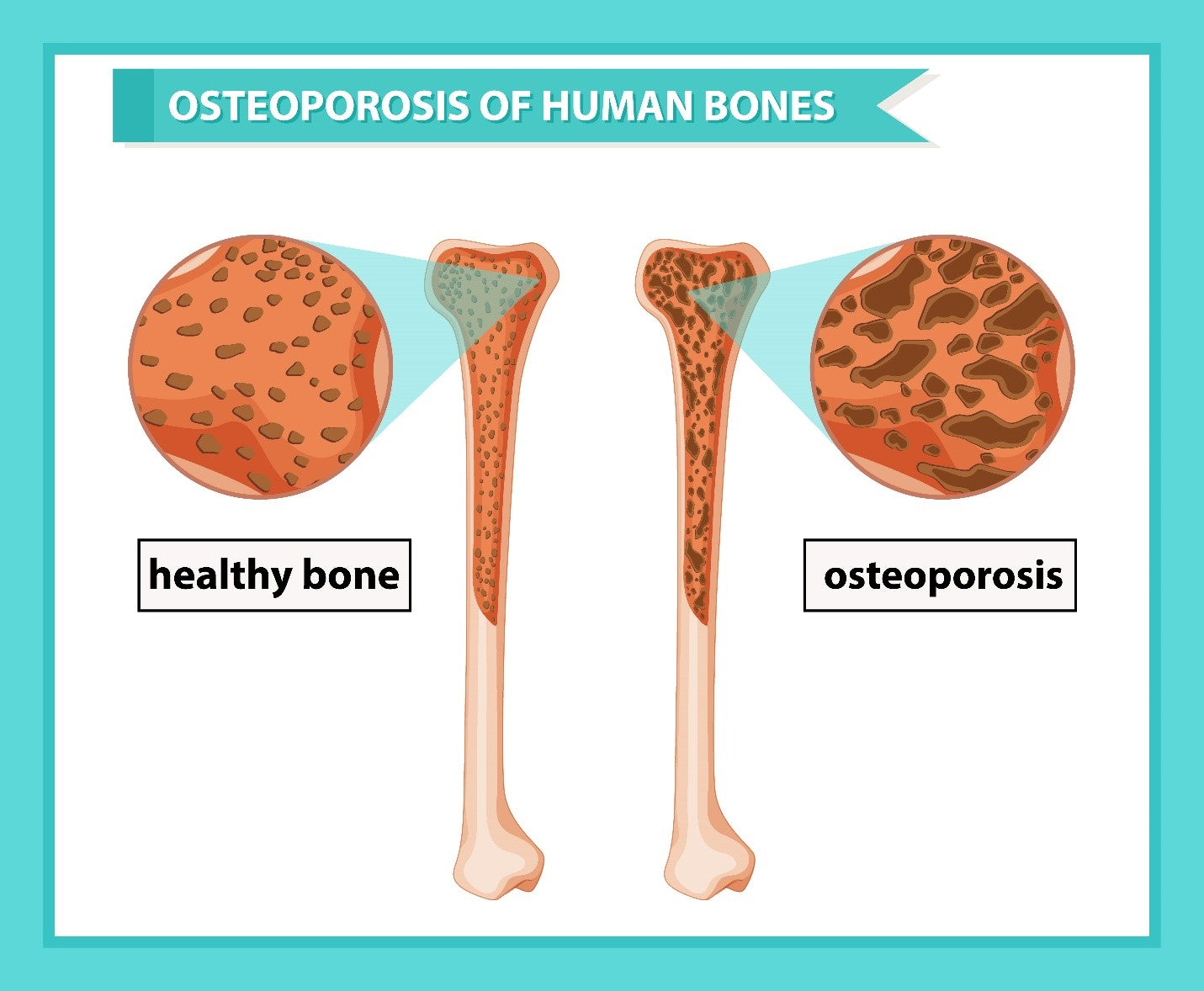 healthybonesvsosteoporosis