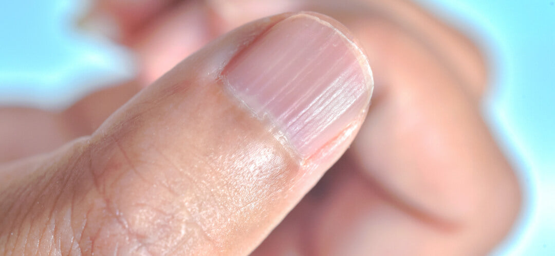 Zinc deficiency and nails: Relationship, signs, treatment, and more