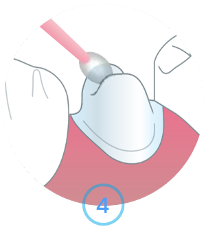 Apply ResiCem Primer on Tooth Surface