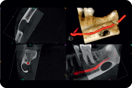 Visualise cysts and periadical lesions