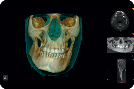 Analyse skeletal symmetry and plan orthodontic surgical treatment